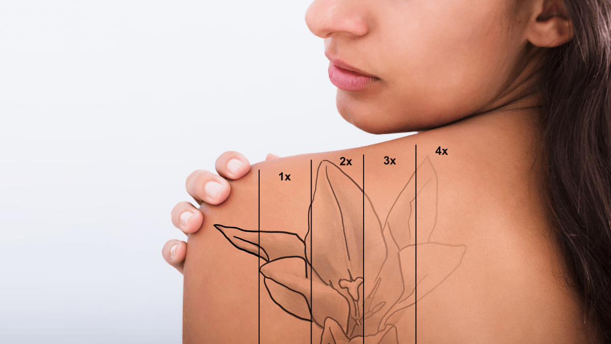 How to remove tattoos without scars